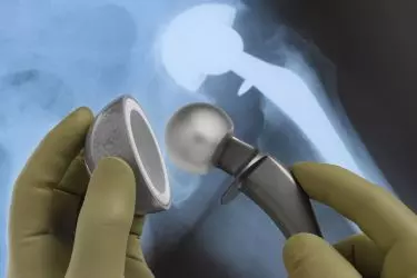 best hospital for hip replacement surgery in purnia, best doctor for hip replacement surgery in purnia, cost of hip replacement surgery in purnia