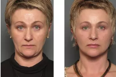 best hospital for facelift surgery in Purnia, best doctor for facelift surgery in Purnia, cost of facelift surgery in Purnia