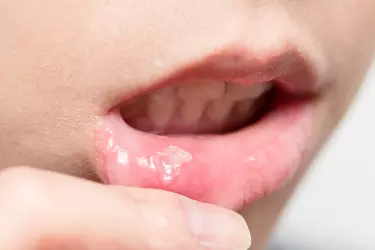 best hospital for mouth cancer treatment in Purnia, best doctor for mouth cancer treatment in Purnia, cost of mouth cancer treatment in Purnia